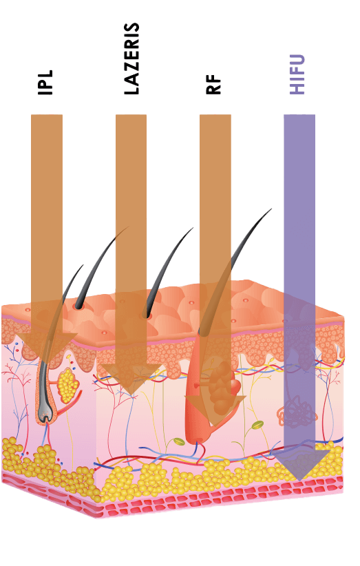 HIFU ultragarso patempimo procedūra